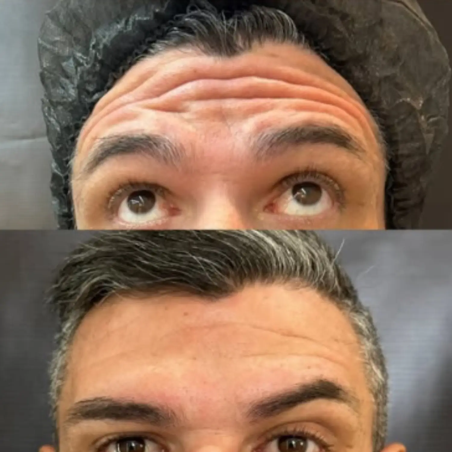Tratamento para rugas e linhas de expressão Clinic Grace Clinica de estética