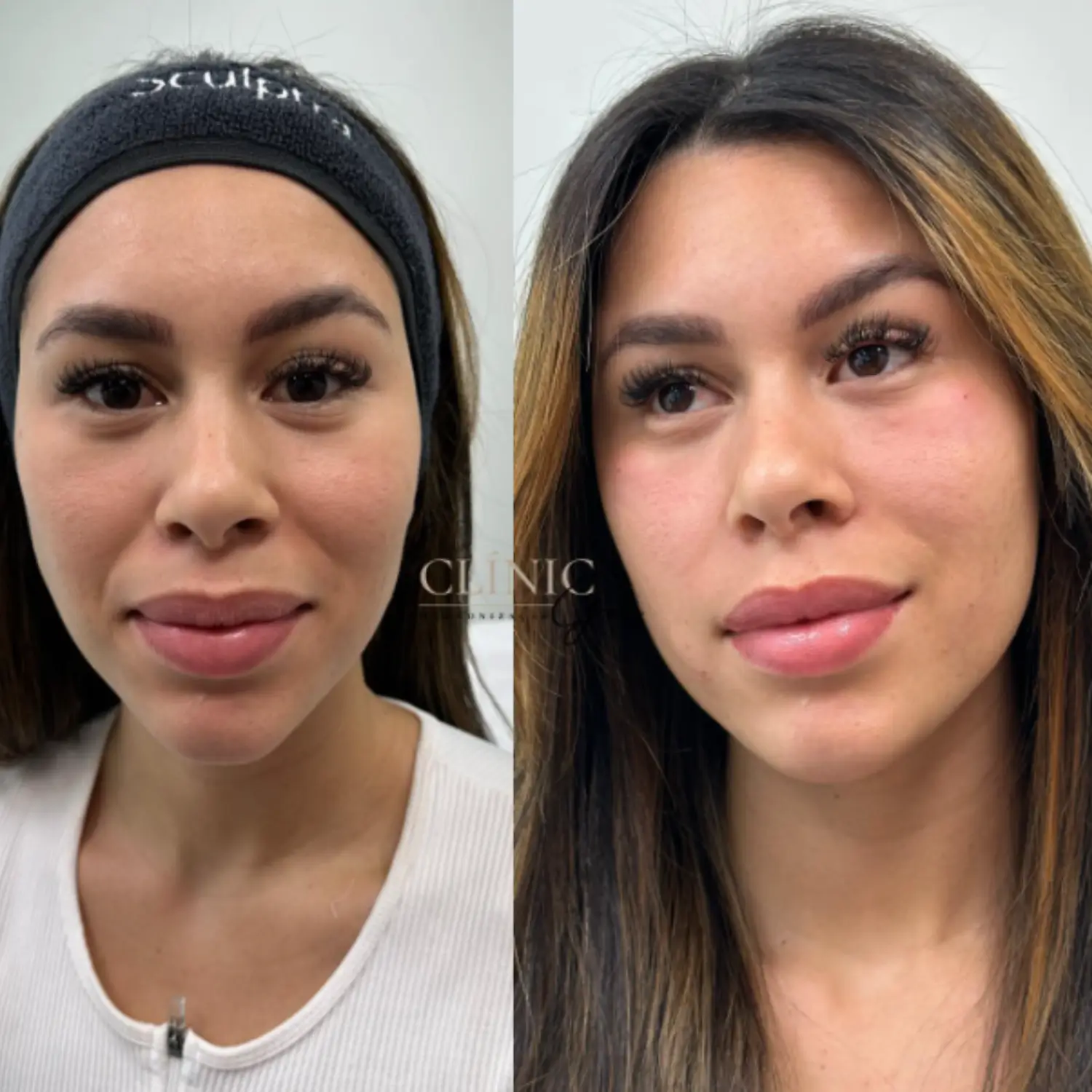 Harmonização facial Clinic Grace Clinica de estética